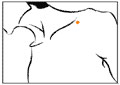 痣的位置与命运图：12、身体上的善凶痣